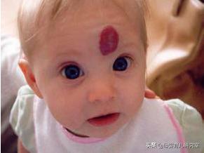 宝宝身上的青胎记能消么,宝宝身上有很多胎记淤青是为什么