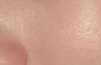 鼻头毛孔粗大如何改善缩小毛孔,皮肤毛孔粗大出汗可以缩小毛孔吗