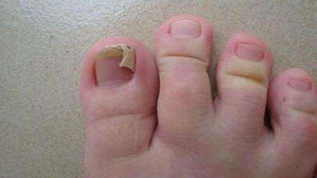 脚趾得了甲沟炎如何正确根治,脚趾甲长进肉里怎么彻底处理