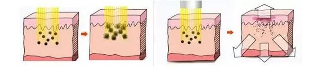 牙科半导体激光美白效果怎么样,激光美白牙齿和冷光美白哪个好