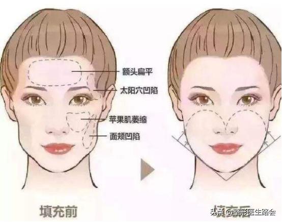 颧骨磨骨苹果肌下垂如何修复,如何判断是苹果肌还是高颧骨