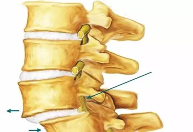 腰椎滑脱坐姿和站姿要注意吗,腰椎滑脱手术拆线后注意事项