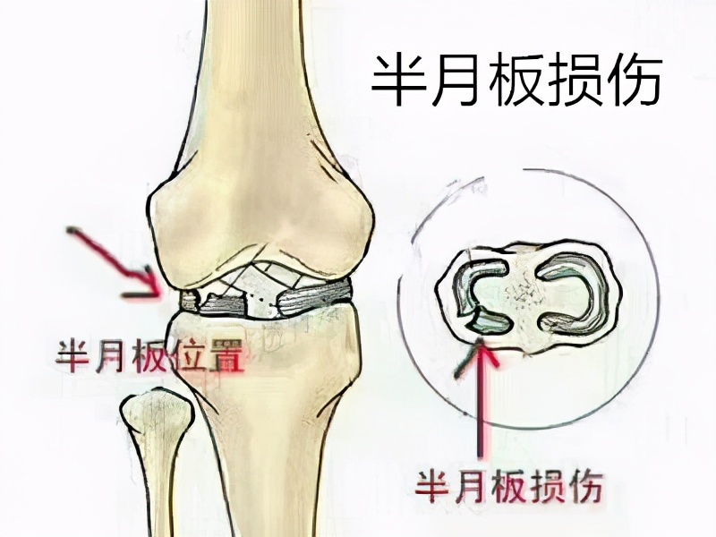 膝盖总是疼半月板损伤怎么治,膝盖一直痛是什么病
