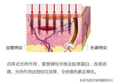 手术后怎么预防疤痕用什么药膏,预防疤痕增生最佳方法