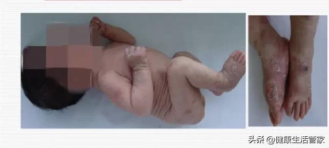 37岁扁平湿疣,男性扁平湿疣