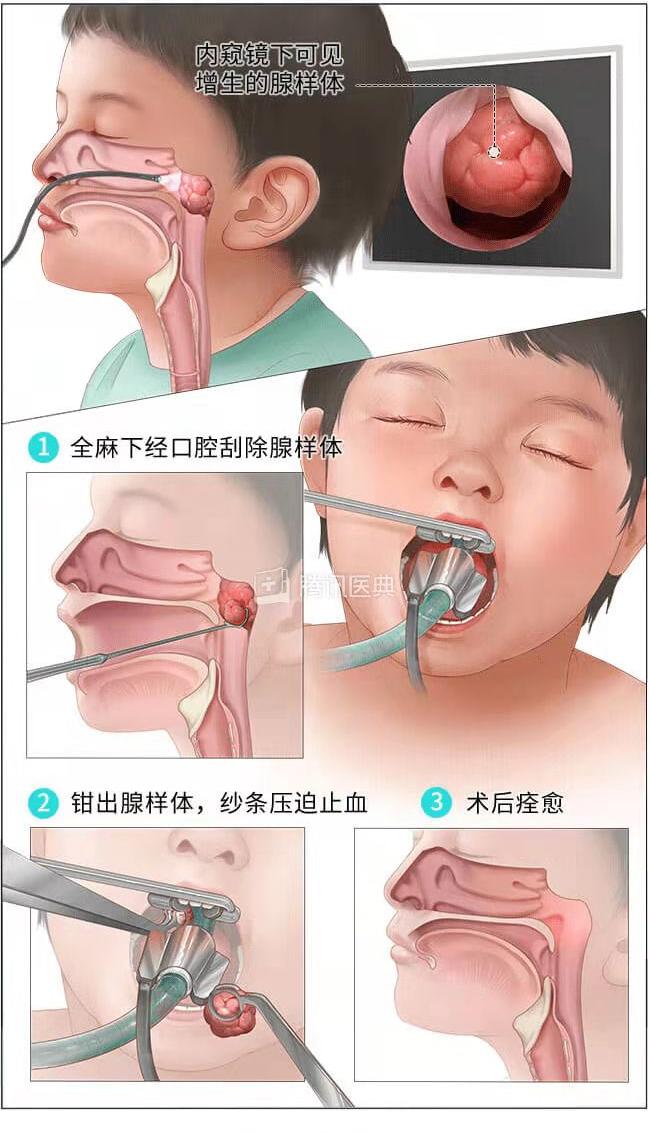 3岁孩子打呼噜感觉嗓子有东西,3岁孩子睡觉打呼噜还咳嗽一下