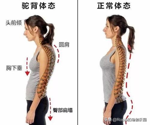居家锻炼含胸驼背体态调整,怎样纠正弯腰驼背含胸