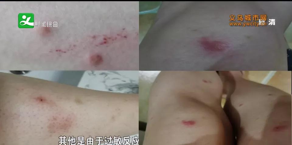 去了海边之后长了小红疹,去海边没暴露的地方起疹子