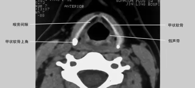 喉部病变做核磁还是ct,耳鼻喉科常见病影像诊断