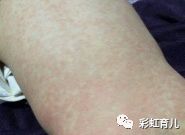 39度一直高烧不退退烧药无效,高烧39.5度很快就退烧怎么回事