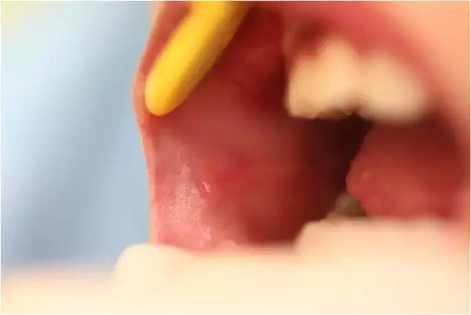 更年期反复口腔溃疡怎么调理,女性反复口腔溃疡是大病前兆