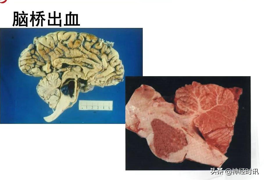 脑动脉解剖学讲解,脑膜中动脉解剖讲解