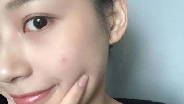 寡肽原液能祛闭合性痘痘吗,寡肽原液祛痘效果好不好