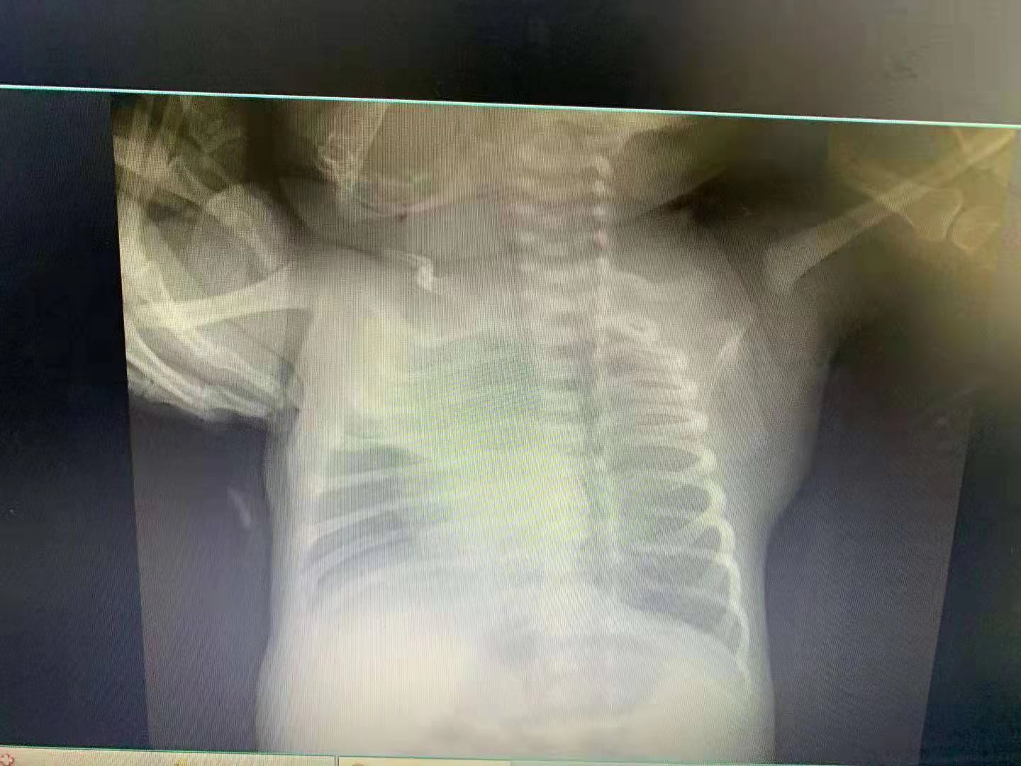 沈阳一月子会所14名婴儿感染,沈阳一月子会所多名新生儿感染