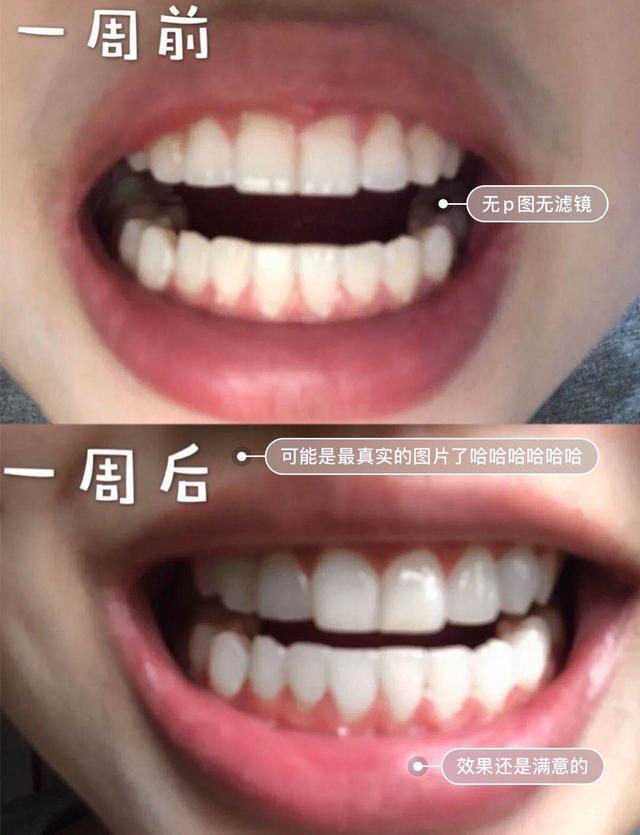 洗牙遭罪不,洗牙难受怎么办