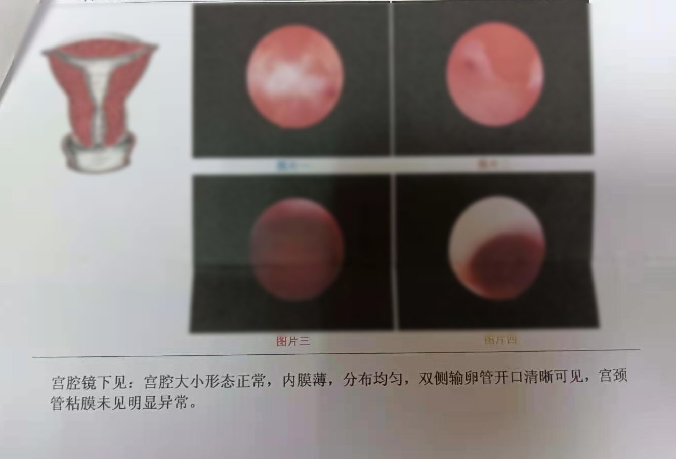 人流后内膜薄吃什么食物,人流引起的子宫内膜薄吃什么中药