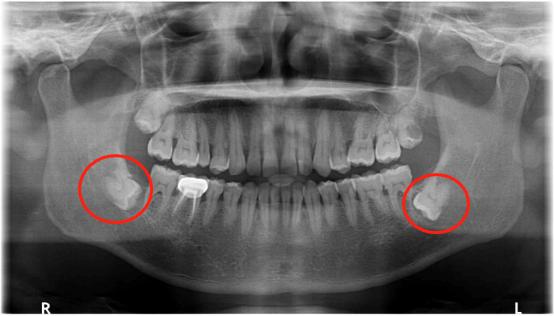 长智齿是不是因为要变聪明,长智齿是不是因为聪明一点