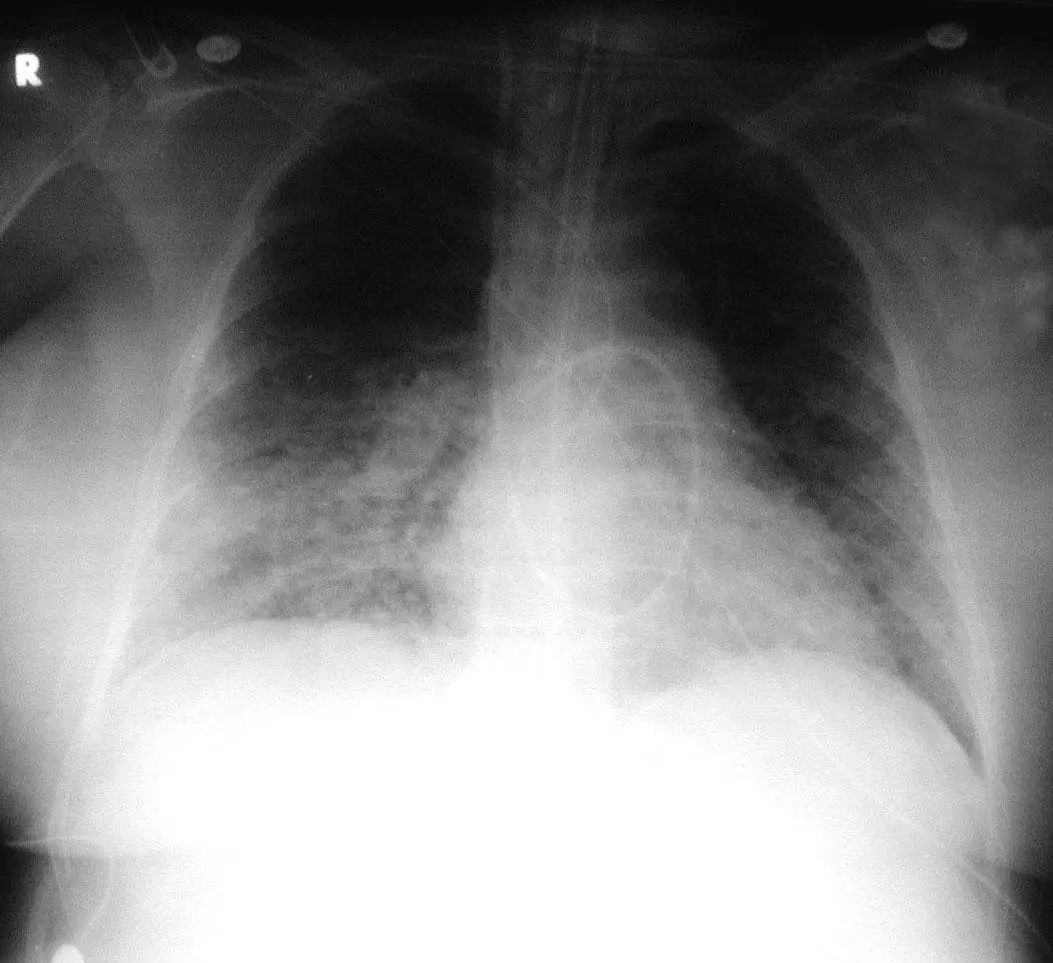 肺炎炎症图片,肺炎病历单图片
