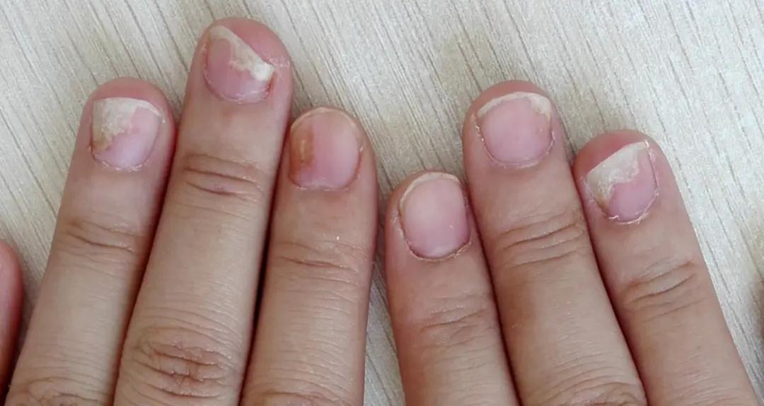 儿童指甲白斑坑洼不平是什么原因,8-12岁儿童指甲白斑是什么原因