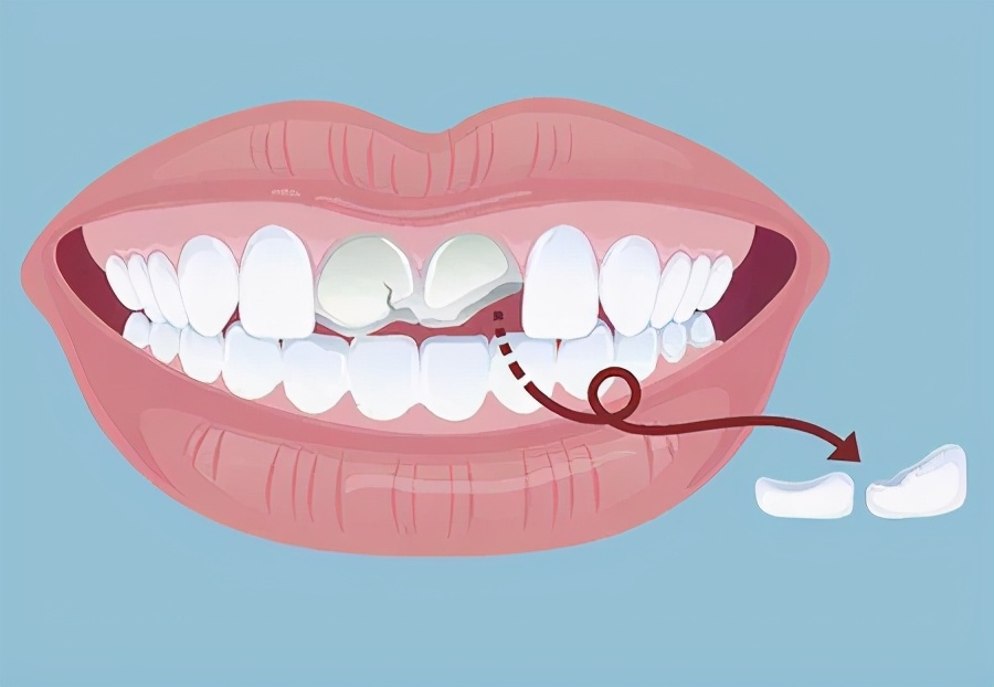 牙齿断裂有什么预兆,牙齿断裂伤到牙髓会怎么样