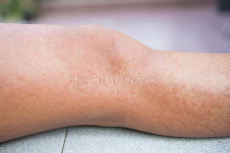 一个荨麻疹患者的治疗经过,荨麻疹患者自述病例