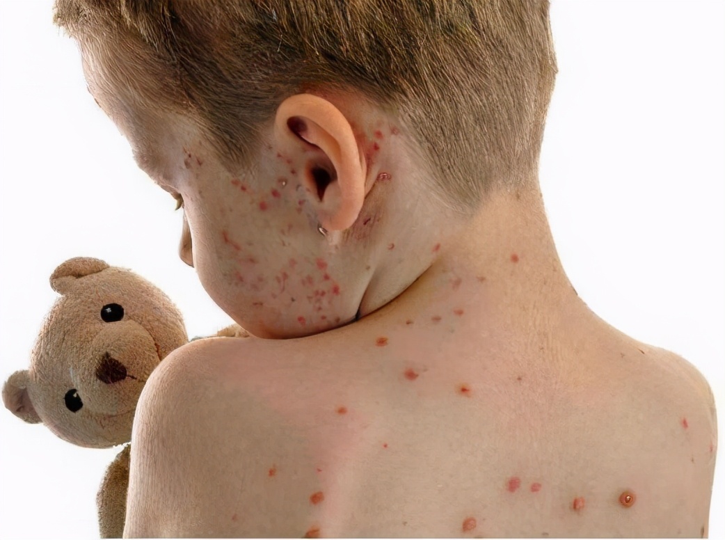 过敏性紫癜是什么症状图片大全,肾型过敏性紫癜的症状能治好吗