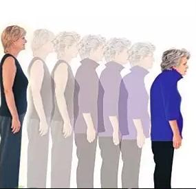 脊柱后凸处理方法,脊柱后凸最佳治疗方法