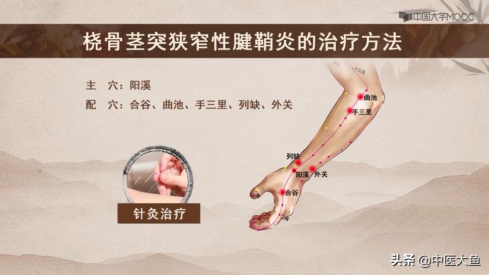 桡骨茎突狭窄性腱鞘炎怎么治疗,桡骨茎突狭窄性腱鞘炎治疗方法