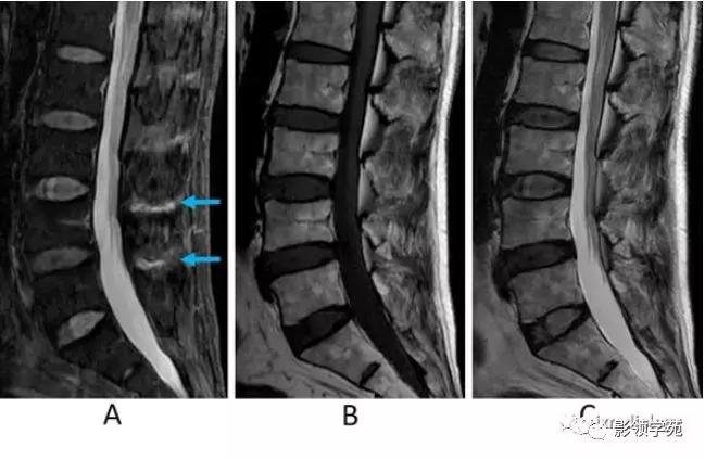 9种椎体和椎旁信号增高的非肿瘤性病变