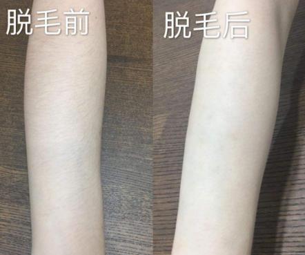儿童如何让汗毛自然脱落不再长,怎样让唇毛自然消失