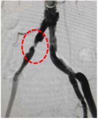 举例科普|介入能治疗哪些疾病?