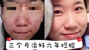 背上长痘千万别用青草药!谭中医为你提供一招妙方