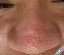 打败毛孔！下一个反孔精英就是你！