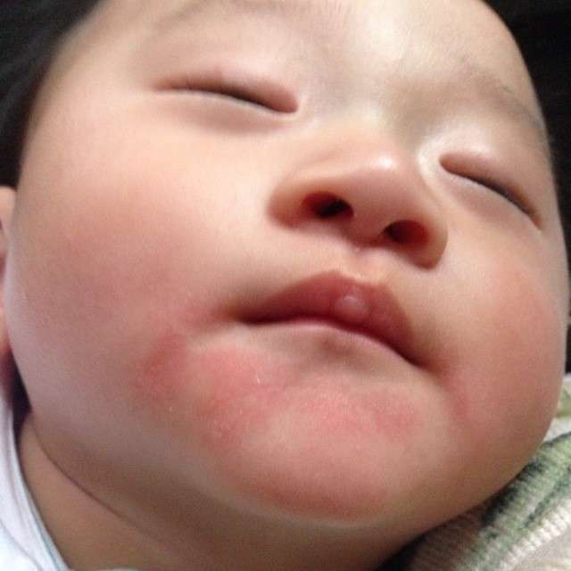 小孩湿疹反反复复不好怎么办,儿童湿疹反反复复如何彻底根除