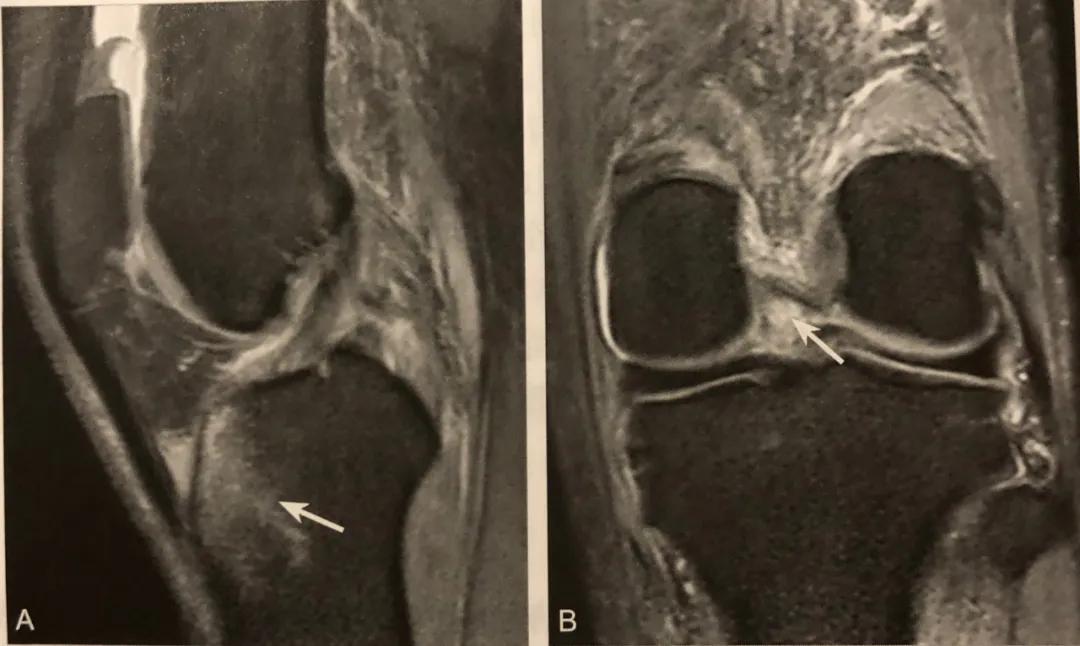膝关节常见损伤的检查方法,膝关节损伤病例图片