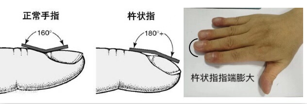 间质性肺病是啥,间质性肺病是什么病严重吗