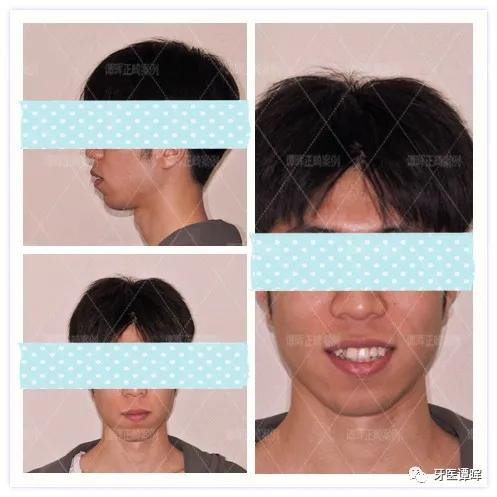 牙齿不齐牙列拥挤怎么矫正,牙列不齐拥挤矫正大约要多少钱