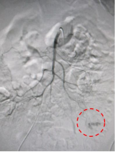 举例科普|介入能治疗哪些疾病?