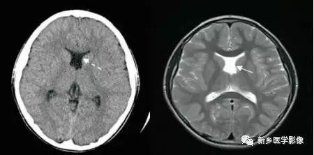 什么引起成人脑室扩大,哪些病可以导致左侧脑室增宽