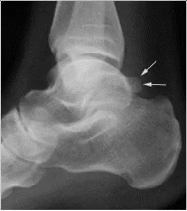 踝关节撞击症问诊,踝关节撞击综合征的x线表现