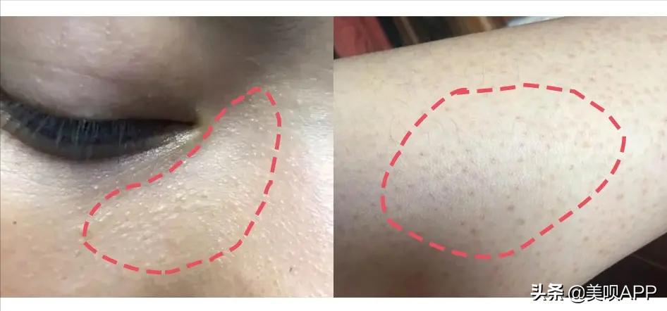 春季鸡皮肤大作战!去毛周角化也要分种类好吗?