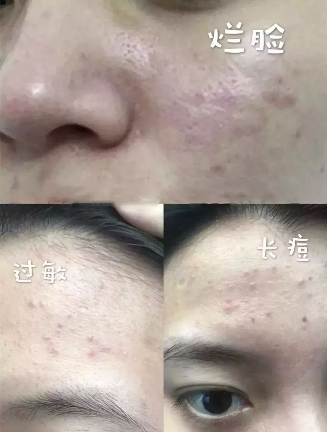 脸上螨虫多出油厉害怎么办,脸上有螨虫痘还痒该怎么办