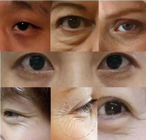 去眼纹去黑眼圈用什么方法,去眼袋眼纹公认最好用的土方法