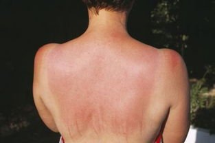 晒伤发红灼痛两天了最快修复方法,大腿晒伤了发红发烫怎么快速修复