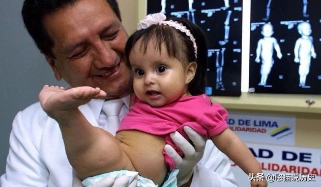 美人鱼真实存在的5件事,美人鱼婴儿畸形手术