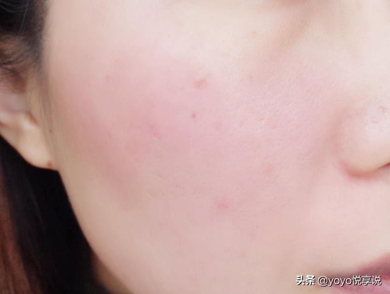 开春脸部刺痛，泛红怎么办？敏感肌换季得有一件神器