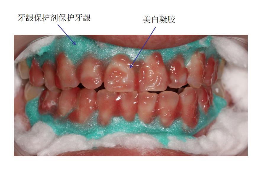 如何选择冷光美白诊所,诊室美白剂使用方法