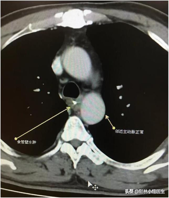 误吞假牙吃什么有助于排出,误吞假牙怎么处理