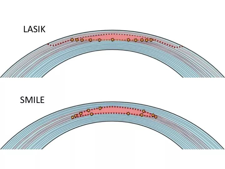 近视手术半年后视力下降重影,飞秒激光近视手术后期视力下降