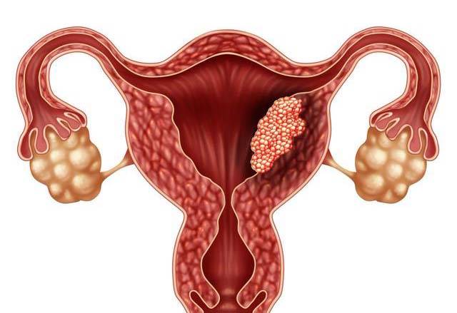 母猪子宫内膜炎的综合防治,母猪子宫内膜炎最佳用药方案